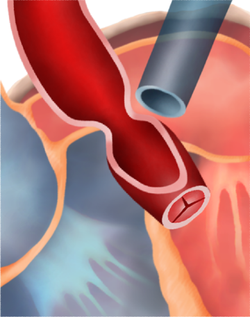 Zwężenie nadzastawkowe aorty
