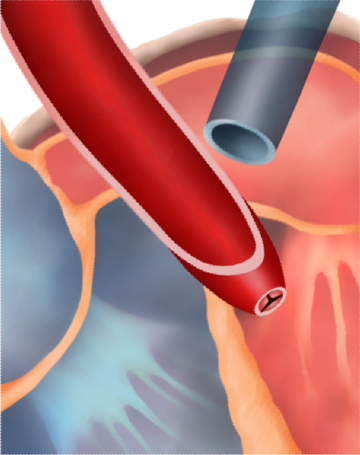 Zwężenie zastawkowe aorty
